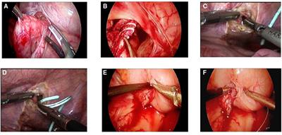 A single-center study of two types of upper kidney preservation surgery for complete duplicated kidney in children